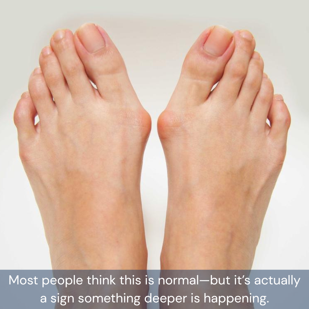 The Hidden Reason Your Bunion Keeps